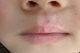 白癜风到底能不能治好？常见的治疗方法有哪些？一篇文章说清楚图片