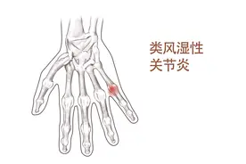 得了类风湿，关节疼痛怎么办？做好这3点，正确服用止痛药图片
