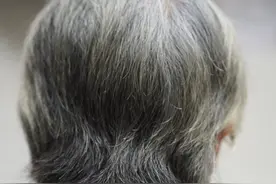 科学家发现头发变白的可能原因图片