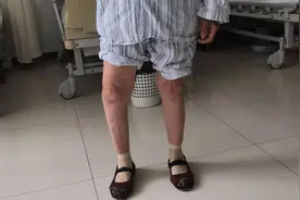 得了关节病不想做手术怎么办呢？图片