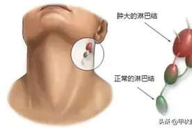 半切且淋巴未转移，为什么术后3年同侧发现了肿大淋巴结？看看吧图片