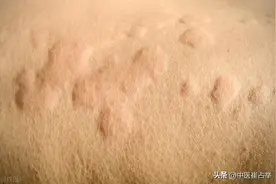 荨麻疹难治？找准病根一点都不难，脾为五脏中心，脾一好，疹自消图片