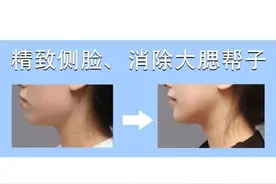 「精致侧脸/提升侧颜」如何消除肥大的腮帮子？图片