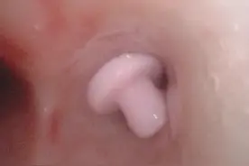 误吞姐姐发卡小饰物，一岁男孩险窒息图片