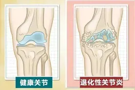 膝盖疼、膝关节炎？日常生活中需要注意哪些事项？图片