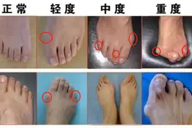 脚底板爱生茧子、走路疼痛是怎么回事？或是这些部位出现了问题图片