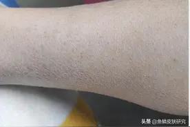 夏季到来，鱼鳞病5大问题一定要解决图片