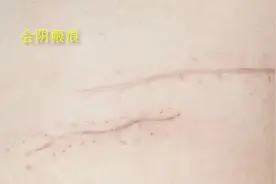 生产后的会阴瘢痕，怎么会引起疼痛图片