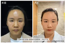 做完“脂肪填充”3个月了，我来说说自己的感受图片