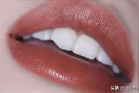 门牙缺了一块拉低颜值？4招帮你摆脱窘境图片