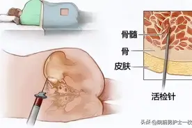 「技术」骨髓穿刺术图片