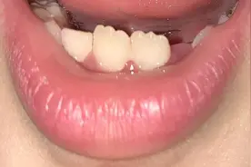 为什么小孩子的牙齿是波浪形的？要补牙吗？补钙呢？图片