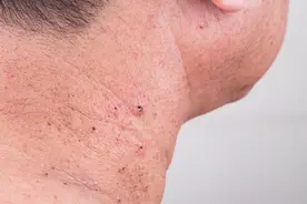 脖子上长小肉粒，可以用手抠掉吗？皮肤这4处变化，或是癌症预警图片