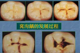 小朋友龋齿防不胜防？从源头“防患”是关键图片