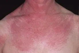 身体有癌，皮肤先报警？提醒：皮肤出现4种异常，或是癌症信号图片