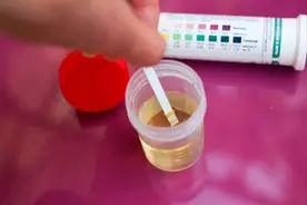 尿常规化验单上出现尿蛋白加减号，是否要治疗及如何治疗？图片