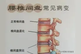 腰椎间盘突出症 | 康复要点，一文总结图片