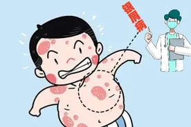 牛皮癣病情好转？通过4点来判断！图片