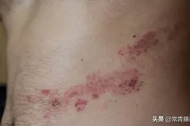 带状疱疹是什么？单纯疱疹是什么？困扰很久的问题终于有了答案图片
