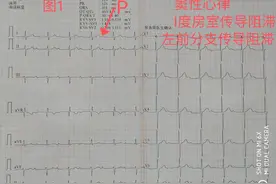 Ⅰ度房室传导阻滞是什么？图片