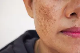 牙膏是老年斑克星？提醒：真正可以淡化老年斑的方式，是这2种图片