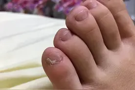 小脚趾指甲分成两瓣的人，到底是什么来历？你的指甲是这样吗？图片