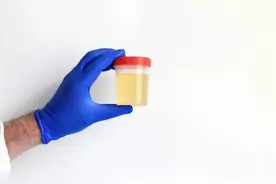尿液变色是疾病前兆？关于尿液的 8 种颜色，一文说清！图片