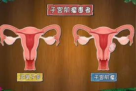 子宫肌瘤的5个症状表现图片