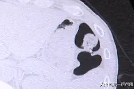 男子肺部长出“蘑菇”命悬一线，医生：与他家发霉有关图片