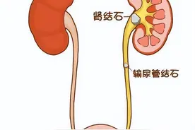 一个治结石非常好用的中药方，胆、肾、膀胱结石都可用，疗效迅速图片