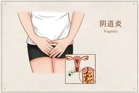 老年性阴道炎预防保养须知图片
