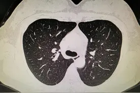 “定心丸”解焦虑，帮助3mm实性肺结节的全职妈妈解除心魔图片