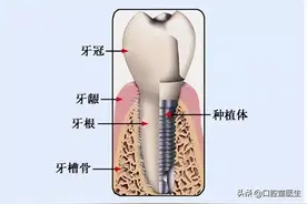我不过想做种植牙，为什么医生要我先植骨，这个植骨是什么？图片