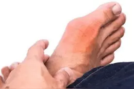 塞来昔布是治疗关节、肌肉疼痛的常用药，与双氯芬酸钠有何区别？图片