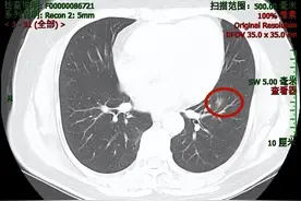 问诊：甲状腺癌术后发现肺部多发结节，是转移吗？图片