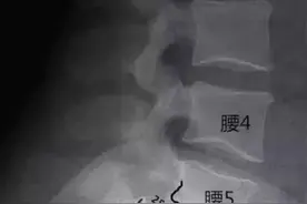 腰椎滑脱程度的分级图解图片