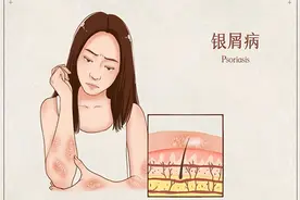 济南市莱芜人民医院皮肤美容科让牛皮癣不再牛图片