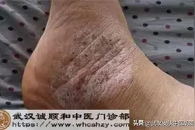 脚上起红斑白屑皮肤干裂脚趾头发黄流脓走路疼得厉害是怎么回事图片