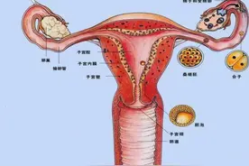 什么是异位妊娠？图片