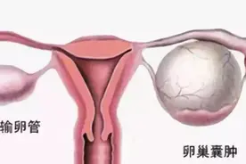 卵巢囊肿有什么症状？出现这4个症状，一定要警惕图片
