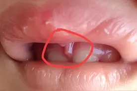宝宝学走路，把上唇系带线磕断裂，爸爸吓坏了，坚持要去医院检查图片