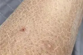 腿上鸡皮肤被老公嫌弃！洗澡时这样做皮肤又嫩又滑图片