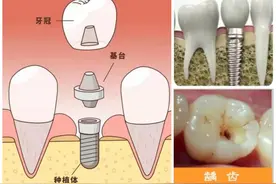 种植牙能进医保吗？图片