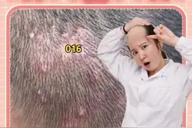 头上经常长“痘痘”，洗头都得小心翼翼，一碰还很疼，有时候抓破还有白色的脓液，这可能是 #毛囊炎   #痘痘 #医学科普 #皮肤  视频封面