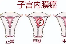 科普 | “ 嫌贫爱富 ” 的子宫内膜癌图片