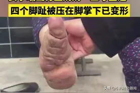 山东：女子晒出村里奶奶“三寸金莲”，四个脚趾被脚掌压得已变形图片