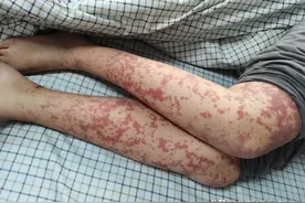 检查出血小板减少，为什么没有出现症状？图片
