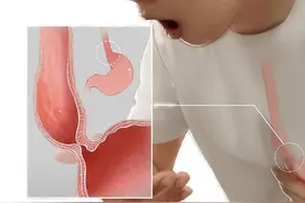 贲门失弛缓症是怎么回事？与食管癌有什么关系？图片