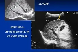 肝超声回声波增粗的意义图片