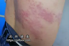 身上长有很多黄色水泡非常疼是什么原因图片